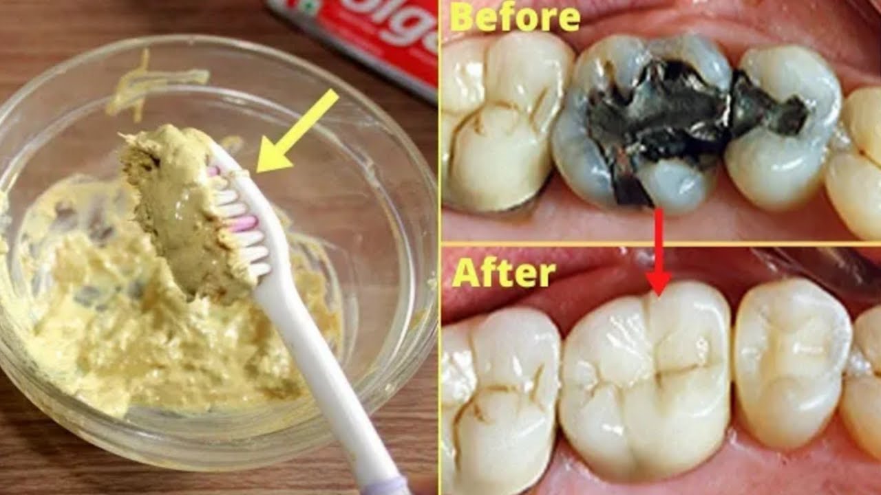 ปวดฟัน ฟันเป็นรู ฟันเป็นแมง ฟันเป็นโพรง หายได้ในครั้งเดียว