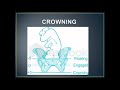 Fetal Crowning & Labor Management 🤰