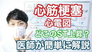 心筋梗塞の心電図変化(ST変化)を簡単に解説してみた【10分で医師が解説】【どの冠動脈でどの誘導？】