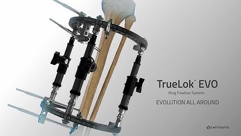 TrueLok™ EVO Ring Fixation System