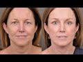 The AuraLyft: Full Facial Rejuvenation