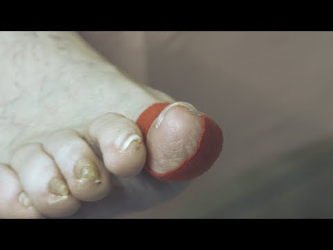 Video: Micoderil proti hubám nechtov