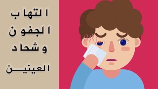 شحاد العين  Stye