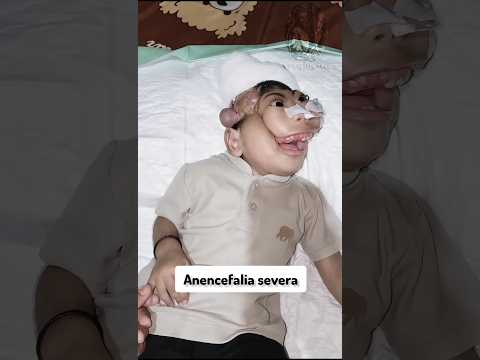 Anencefalia