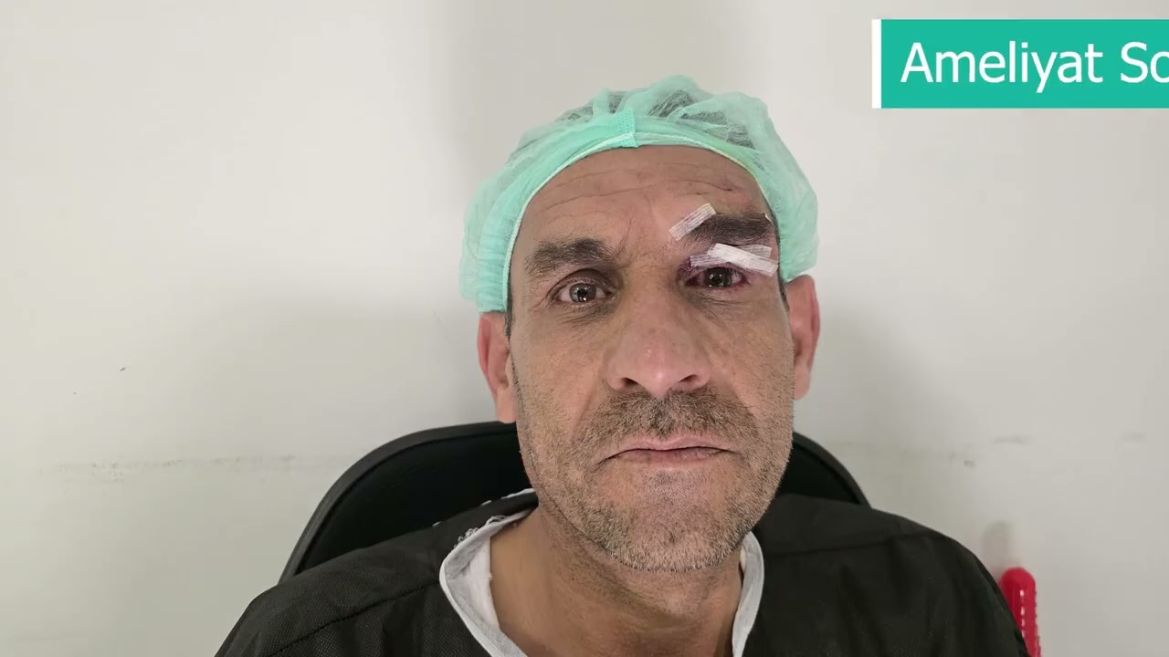 Göz Kapağı Düşüklüğü (Pitoz) Nedir? Nasıl Tedavi Edilir?