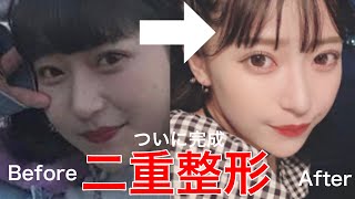 【整形】二重整形がやっと完了しました。【経過報告】