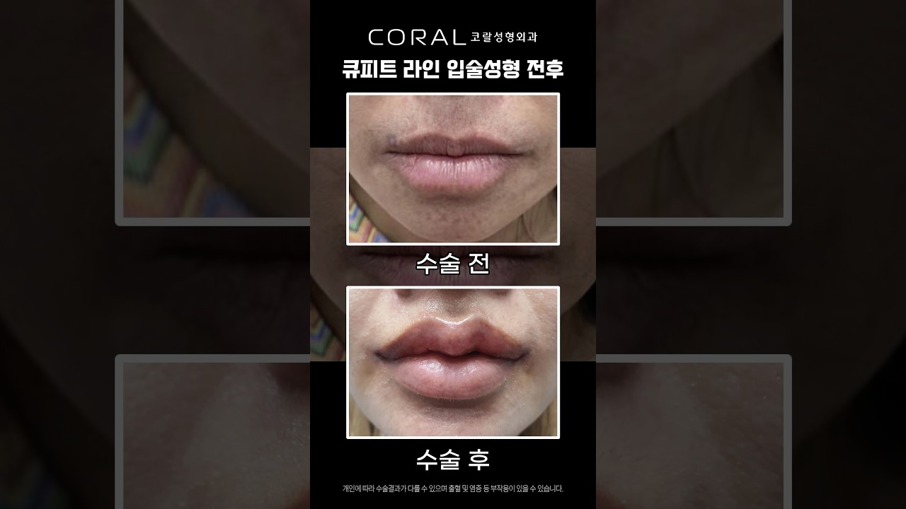 러블리한 큐피트 라인으로 변신💘 #shorts #입성형