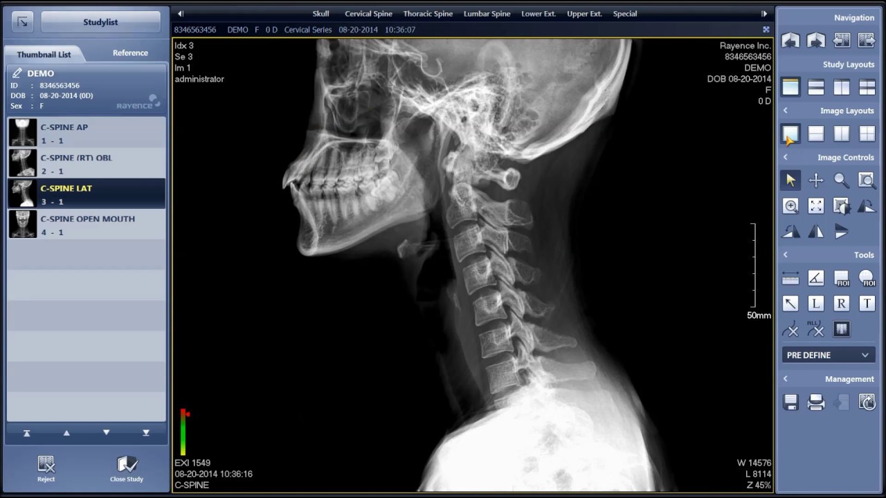 Rayence Xmaru Chiroview Chiropractic X-ray Viewing Software - YouTube