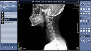 Rayence Xmaru Chiroview Chiropractic X-ray Viewing Software