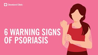 6 Warning Signs of Psoriasis