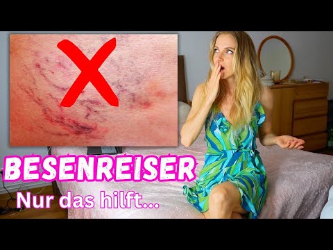 Video: 3 Möglichkeiten, Besenreiser zu verhindern