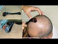 How to use derma roller | Second day of Hair treatment