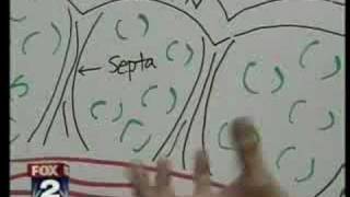 Fox News Detroit - Dr. Youn Demonstrates Anti-Cellulite Treatments In Michigan