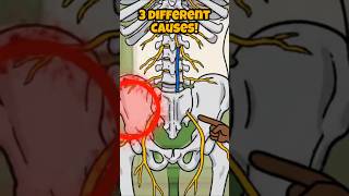 3 Causes of Lower Back Pain (Most Miss #3)