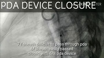 PDA (Patent ductus arteriosus) device closure | Congenital heart disease
