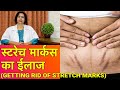 स्ट्रेच मार्क्स का ईलाज || How To Get Rid of Stretch Marks (In HINDI)