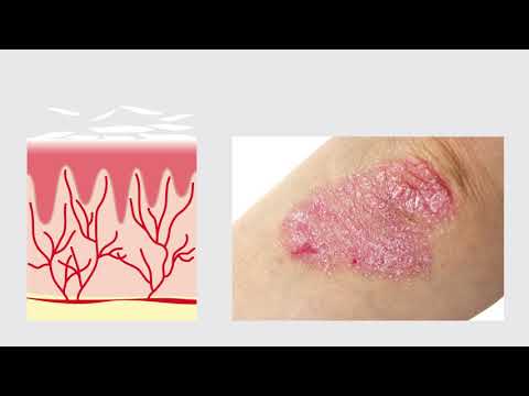 Video: Alasan Mengapa Pengobatan Psoriasis Anda Tidak Berfungsi