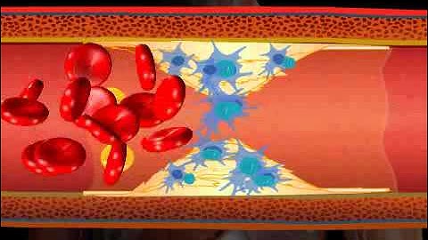 Understanding Cholesterol and its Effects