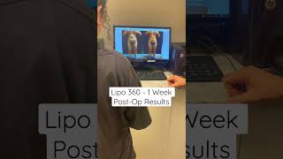 Lipo 360 - 1 Week Post-Op Results