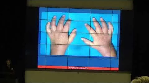 Dr. Deborah Parks- Muskuloskeletal Sarcoidosis
