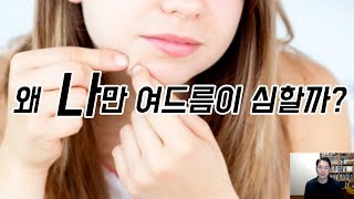 내 여드름이 다른 사람보다 심한 이유 : 연구가 진행중이다?