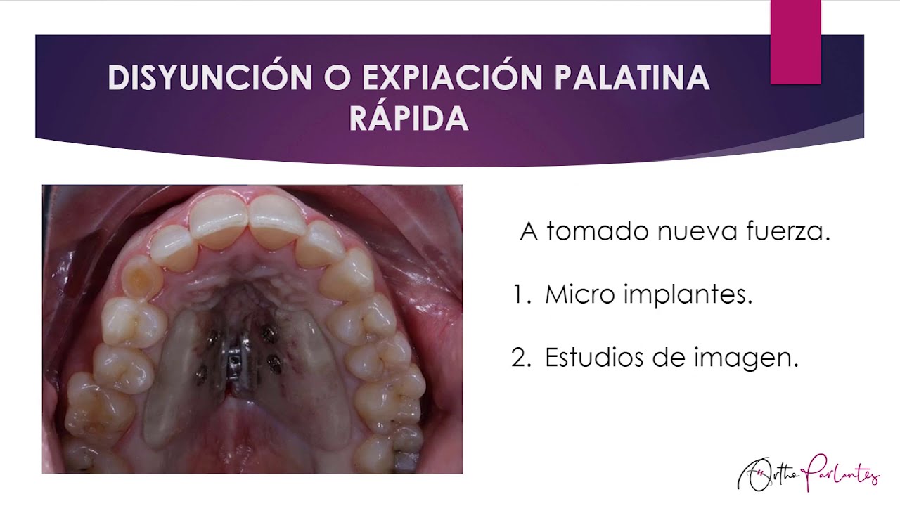 Disyunción Maxilar | OrthoCápsula