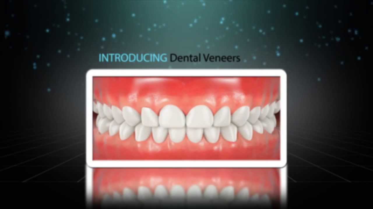 Gemini Dentals | Introducing Dental Veneers