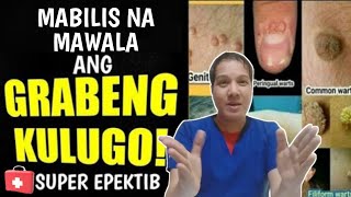 ISANG PINAKA MABISANG GAMOT UPANG MABILIS MATANGGAL ANG KULUGO | Warts Solution. ISANG PINAKA MABISANG GAMOT UPANG MABILIS MATANGGAL ANG KULUGO | Warts Solution.