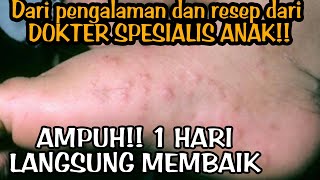 SOLUSI MENGATASI KUTU AIR PADA ANAK DENGAN CEPAT