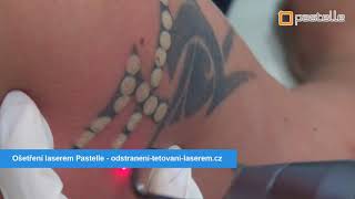 Odstranění tetování laserem Pastelle - Premier Clinic