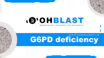 #50SecondBloodFilm: G6PD deficiency (oxidative stress)