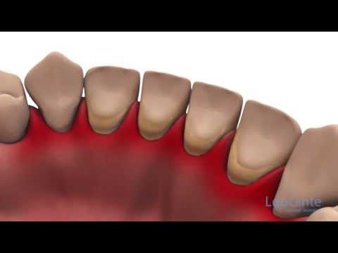 Vidéo: Comment La Plaque Dentaire Se Forme Sur Les Dents