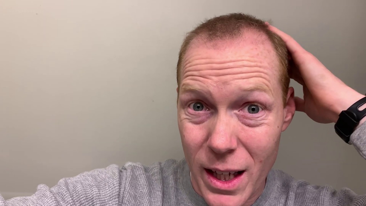 3 Months! I’m Finally Seeing A Change! Redhead Hair Transplant 4K 12 YouTube