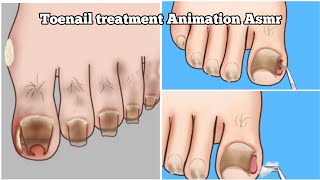 Satisfying Ingrown toenail removal treatment animation | ASMR Ingrown Toenail Removal Animation