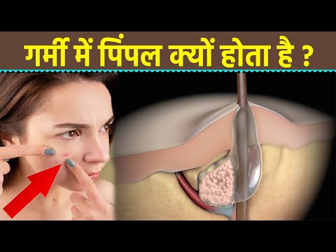 वीडियो: क्या धूप में निकलने से मुहांसे हो जाएंगे?