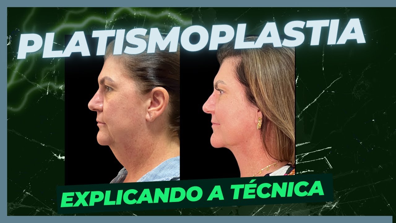 PLATISMOPLASTIA, a técnica que elimina a papada! - YouTube