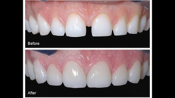 Sửa răng cửa thưa thật đơn giản bằng mặt dán sứ Veneer