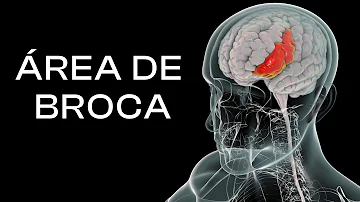 ¿Qué ocurre cuando se daña el área de Broca?