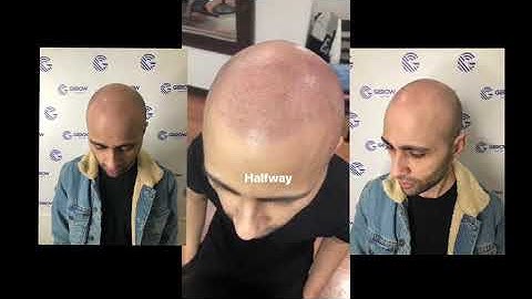 What does a First session of ScalpMicropigmentation look like?