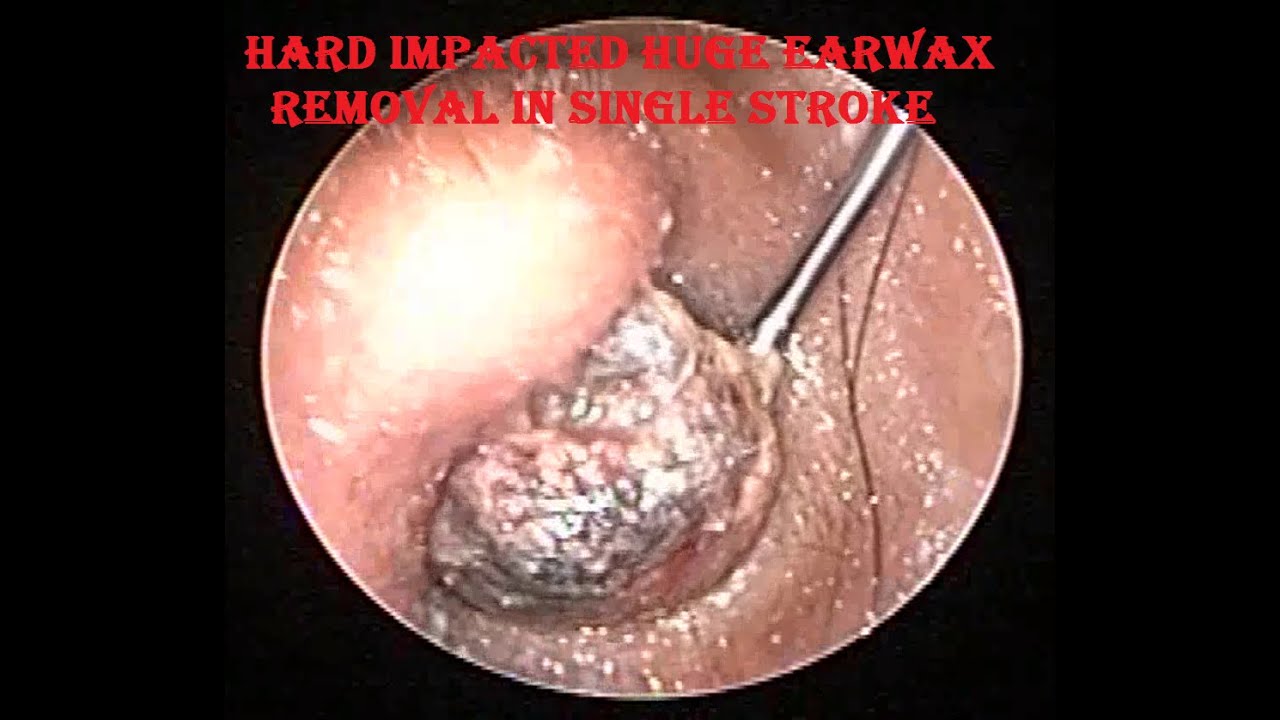 impacted ear wax removal at home