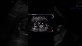 Sweet baby boy blowing kisses at his 14 week appointment pregnancy baby ultrasound pregnancytips