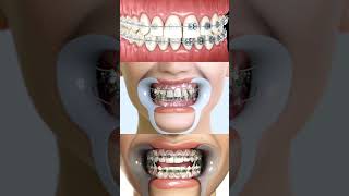 Dental Braces Process #shorts #dentist