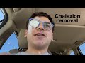 Getting my chalazion removed (again) My experience