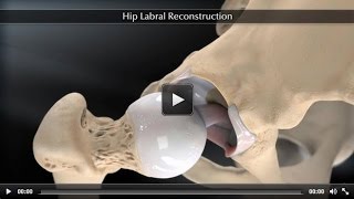 Hip Labral Reconstruction