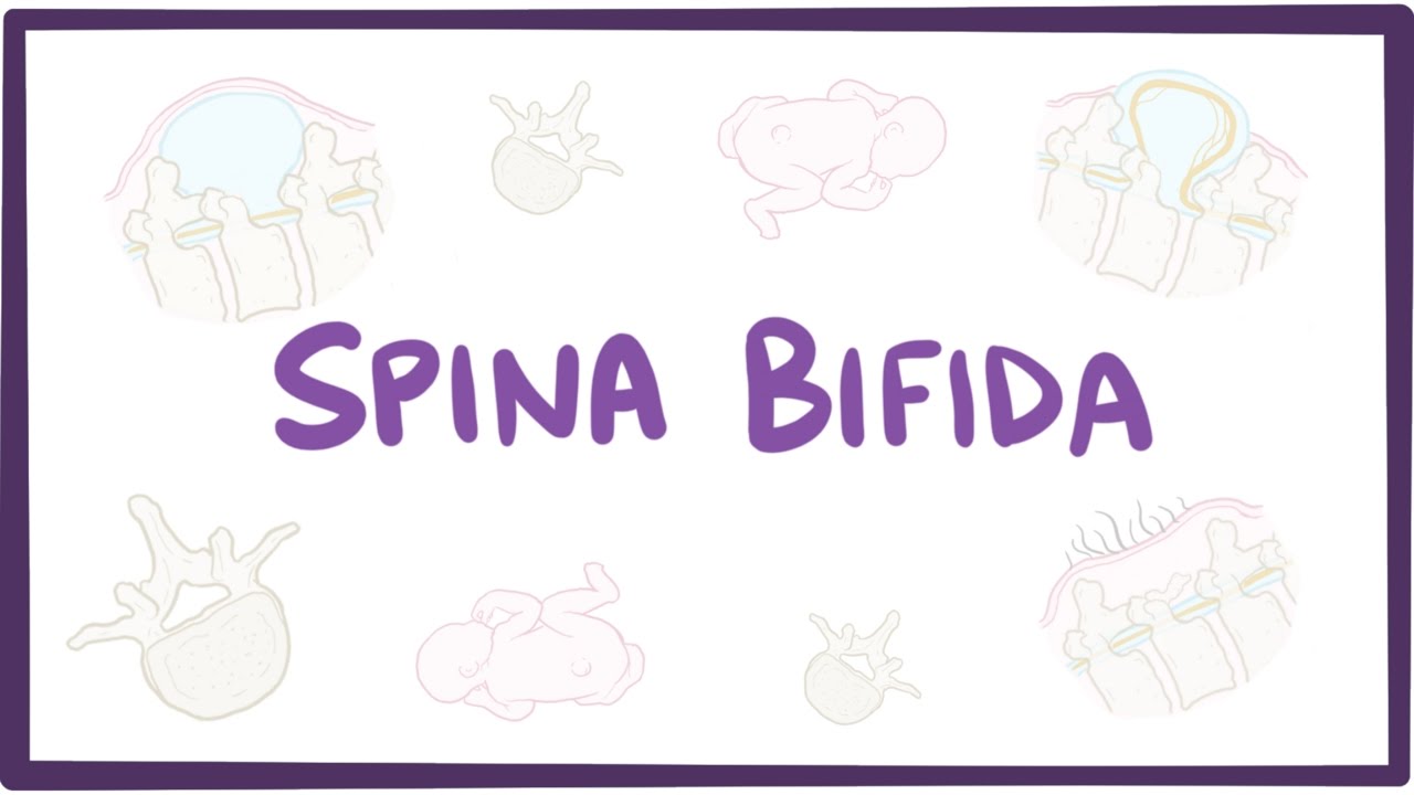 Spina bifida (myelomeningocele, meningocele, occulta) - causes, symptoms, treatment