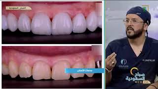 عدسات الأسنان.. مع أخصائي تجميل الأسنان د. ضيف الله الشهري.