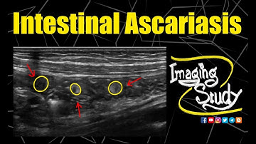 Intestinal Ascariasis || Ultrasound || Case 207