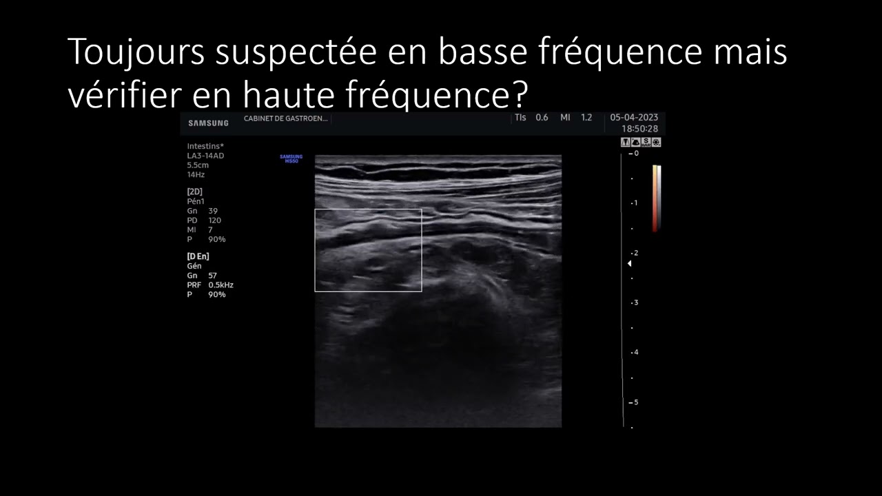 diagnostic et caractérisation d' iléite diagnostic et suivi de subocclusion sous traitement médical