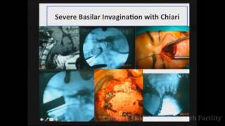 Posterior Approach C1, C2 Facet Distraction/DCR Technique In AAD