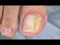 Ela sentiu  um alívio na hora #satisfying #nails